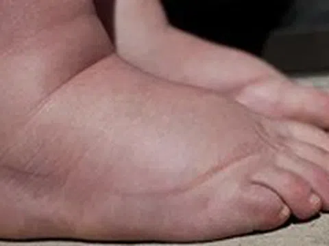 Trẻ đột nhiên bị phù, coi chừng mắc bệnh lý thận nguy hiểm
