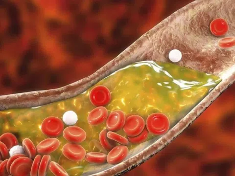 Ăn gì để đẩy lùi cholesterol xấu, mỡ máu cao?