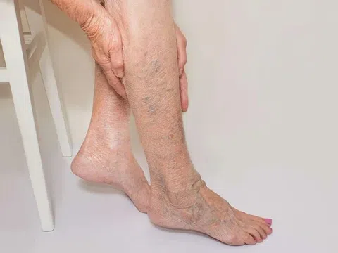 Các yếu tố nguy cơ gây suy tĩnh mạch chi dưới