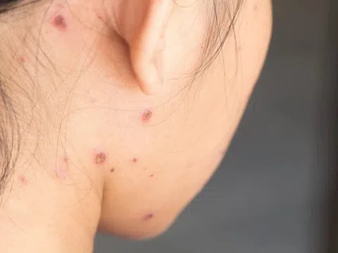 Đã từng mắc thủy đậu có cần tiêm vaccine?