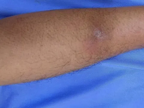 Sán 'đục lỗ' trên cơ thể người đàn ông có thói quen ăn đồ sống