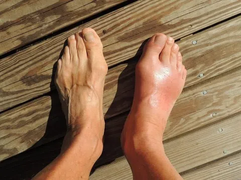 7 yếu tố làm tăng nguy cơ mắc bệnh gout