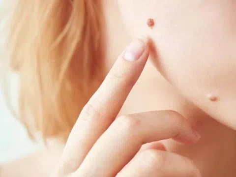 Có 8 dấu hiệu này trên mặt, nên đi khám sớm