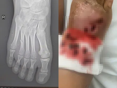 Bé gái suýt mất chân vì bó thuốc nam chữa gãy xương tại nhà