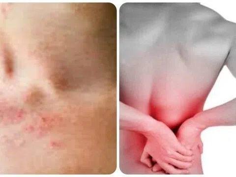 Những triệu chứng suy thận nhẹ bạn cần biết