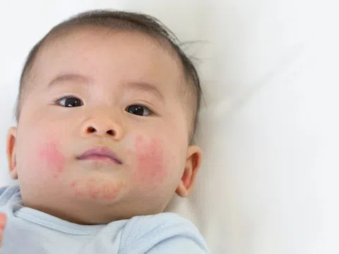 Dấu hiệu cảnh báo trẻ bị viêm da cơ địa