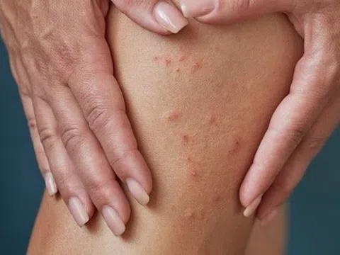 Dấu hiệu chứng tỏ bạn đang bị ghẻ