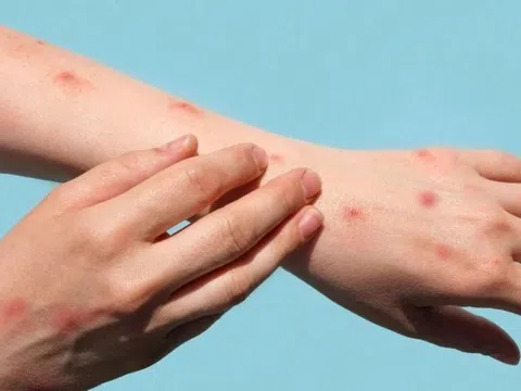 Những dấu hiệu đầu tiên của bệnh thủy đậu