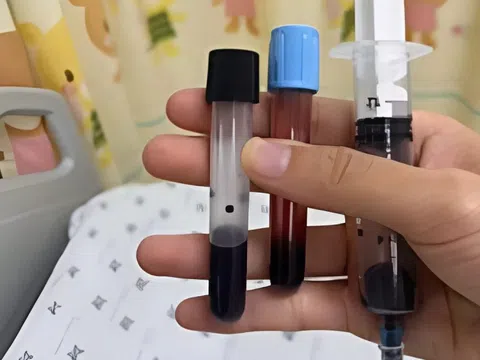 Máu bé gái chuyển đen do ngộ độc methemoglobin