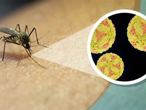 Dấu hiệu điển hình bệnh viêm não Nhật Bản
