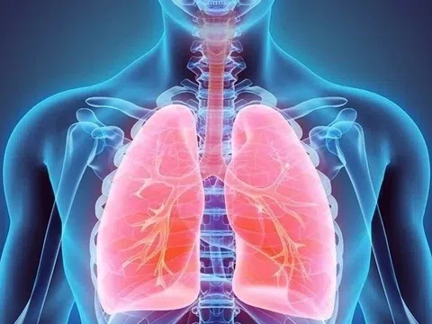 Căn bệnh gây tổn thương phổi gấp 3 lần hút thuốc