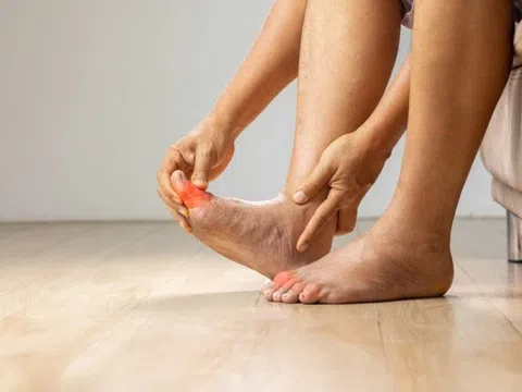 Dấu hiệu ở tay chân cảnh báo axit uric cao
