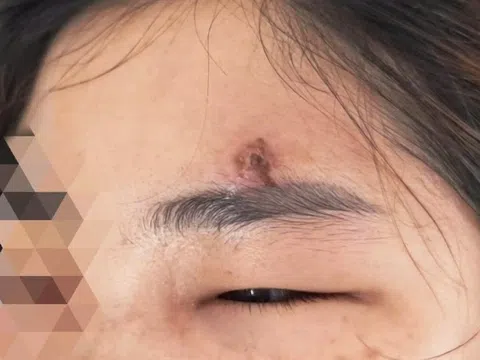 Tự nặn mụn, người phụ nữ ở Hà Nội bất ngờ rơi vào nguy kịch