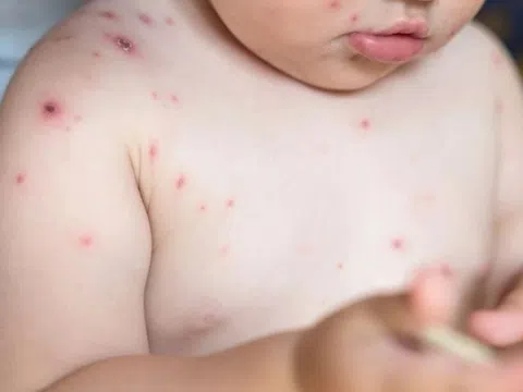 Căn bệnh quen thuộc có thể cướp sinh mạng trẻ sơ sinh trong vài ngày