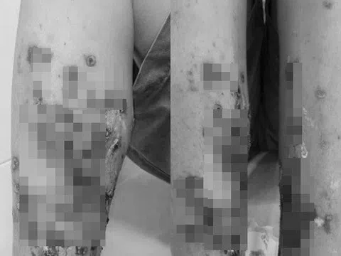 Lội nước bẩn, người đàn ông phải nhập viện vì viêm da lan rộng