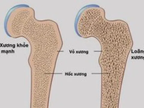 Làm gì để phòng ngừa bệnh loãng xương?