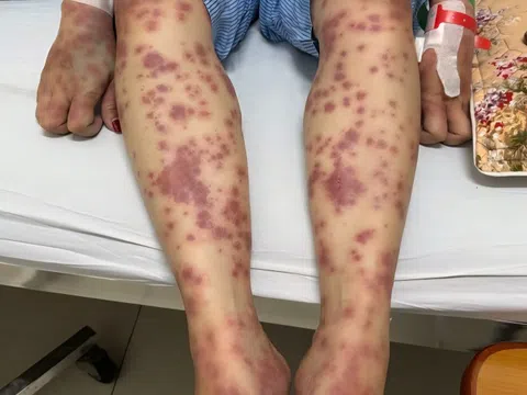 Nữ bệnh nhân nguy kịch vì thuốc giảm cân không rõ nguồn gốc