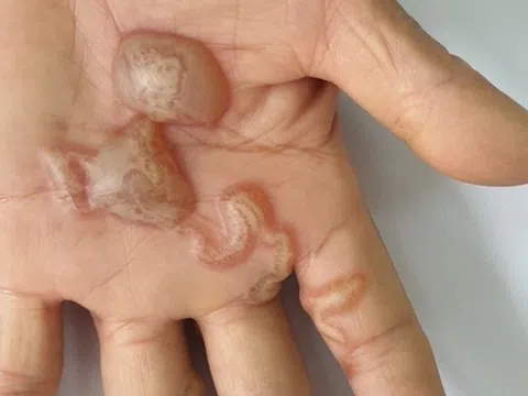 Căn bệnh 'ám ảnh' người yêu chó mèo, hàng chục nghìn ca mắc mỗi năm