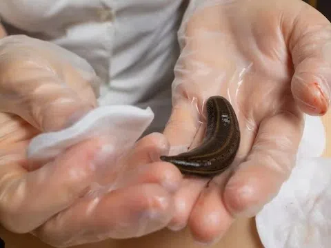 Người đàn ông bị đỉa chui vào niệu đạo khi đang làm việc ngoài đồng