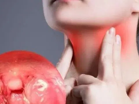 Viêm họng cấp có thể gây ra biến chứng gì?