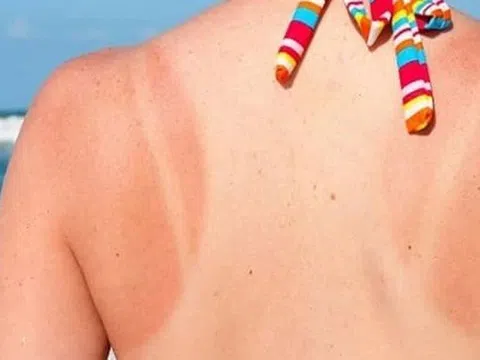 Cách phục hồi làn da sau rám nắng mùa hè