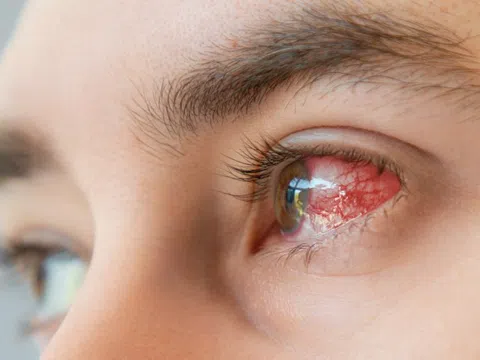 Dấu hiệu sớm cảnh báo bạn bị đau mắt đỏ