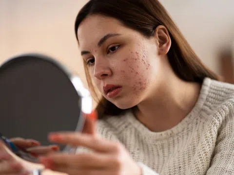 Cách xử lý mụn trứng cá, phục hồi làn da khỏe mạnh sau mụn