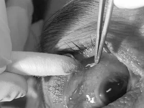 Bất ngờ phát hiện giun trong mắt người phụ nữ