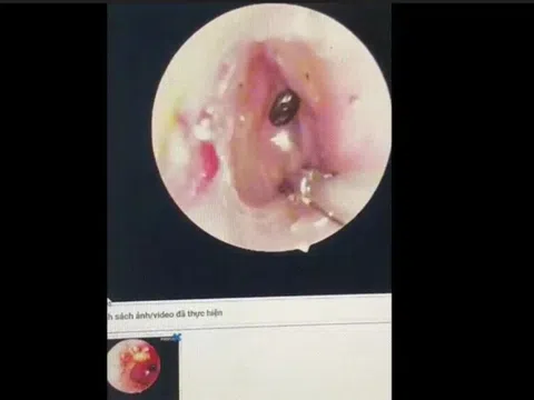 Bọ chét chó làm tổ trong tai bé 9 tuổi