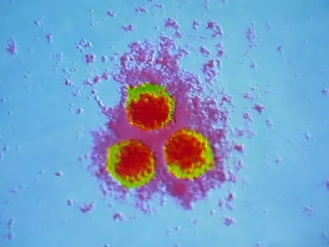 Một loại virus 'ngủ quên' bỗng tái phát gây liệt mặt