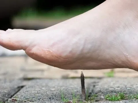 Cách duy nhất để phòng uốn ván khi giẫm phải đinh