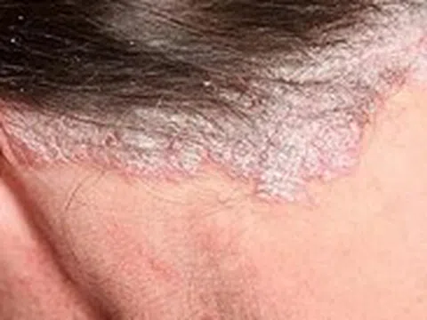 Bệnh vảy nến có thể trị khỏi được không?