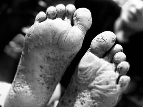Đôi bàn chân lở loét của người dân vùng lũ Nghệ An gây 'bão mạng'