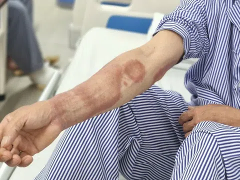 Vết loang kỳ lạ trên da hé lộ căn bệnh tưởng đã bị quên lãng