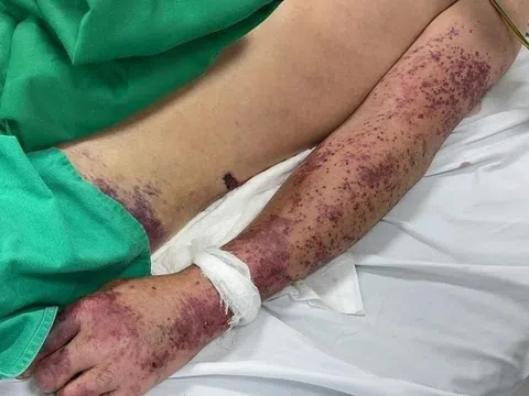 Sau vài ngày sốt cao, người đàn ông ở Hà Nội không qua khỏi