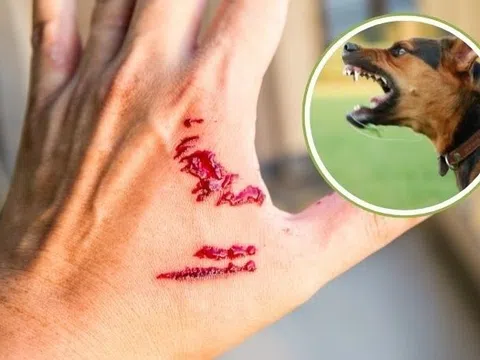 Xử trí vết thương đúng khi bị chó, mèo cắn để phòng bệnh dại