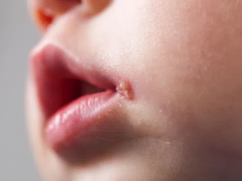 Nhiễm HSV ở trẻ sơ sinh