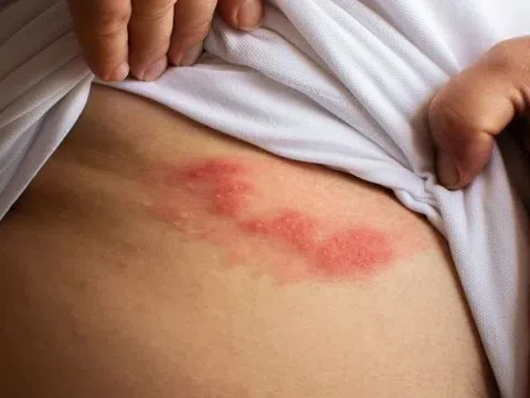 Biểu hiện chứng tỏ bạn đang mắc giời leo