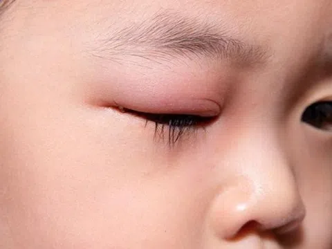 Viêm bờ mi mắt cần chăm sóc như thế nào?