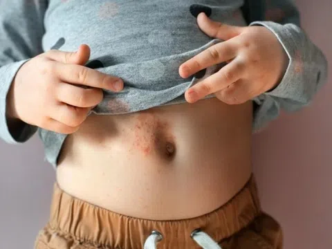 Dấu hiệu cảnh báo bệnh ghẻ ở trẻ