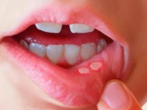 Lưu ý đặc biệt khi bị nhiệt miệng