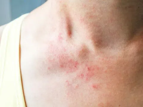 Nhận diện nốt phát ban nguy hiểm