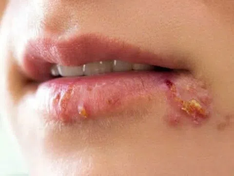 Vì sao zona thường tái phát và gây đau kéo dài?