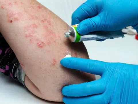 Nhận biết các loại vảy nến thường gặp