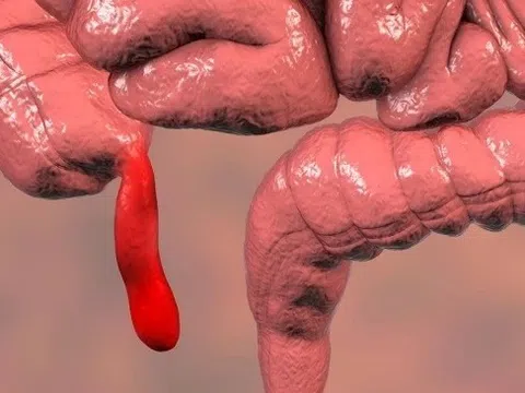 Hình ảnh ruột thừa vỡ mủn nát khiến bác sĩ sốc