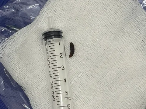 Giòi ngo ngoe trong tai bệnh nhi khiến bác sĩ sốc