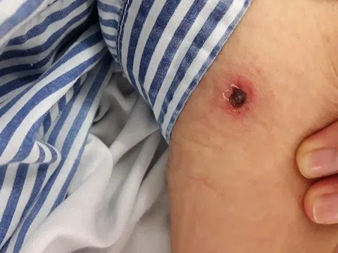 Nguy kịch vì vết loét ở vị trí không ai ngờ tới