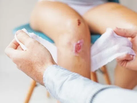 Dấu hiệu vết thương hở có thể bị nhiễm trùng