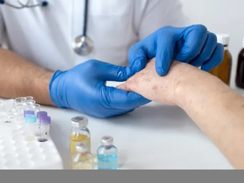 Vì sao có người mắc thủy đậu hai lần?