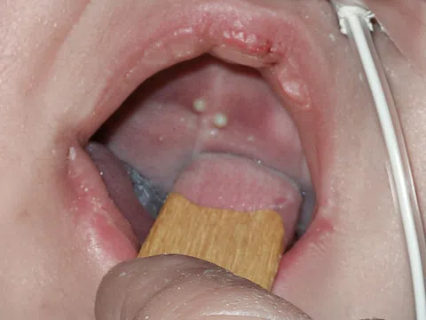 Con bạn có nanh sữa khi vừa sinh, có cần điều trị sớm?